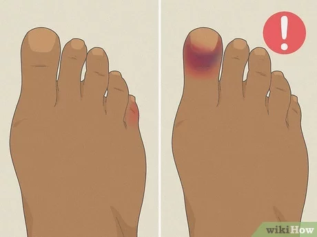 Attelle pour un doigt de pied cassé : conseils et astuces